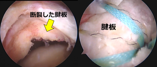 修復術後の腱板の写真