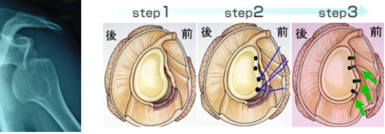 反復性肩関節脱臼